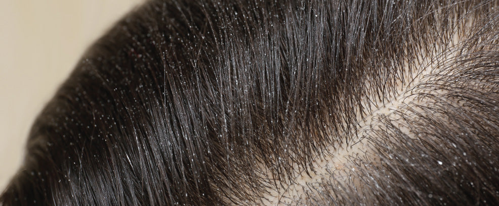Dandruff